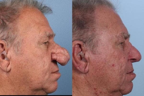 Ринофіма носа: симптоми, причини і методи лікування