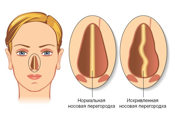 Септопластика носової перегородки: види, як роблять, відновлення