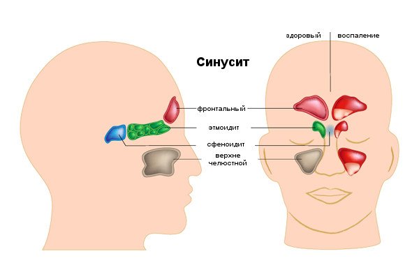 Синусит і гайморит: у чому різниця і чим відрізняються захворювання