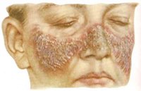 Туберкульоз носа: симптоми, лікування та профілактика
