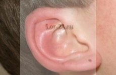 У дитини червоне вухо зовні – причини, лікування