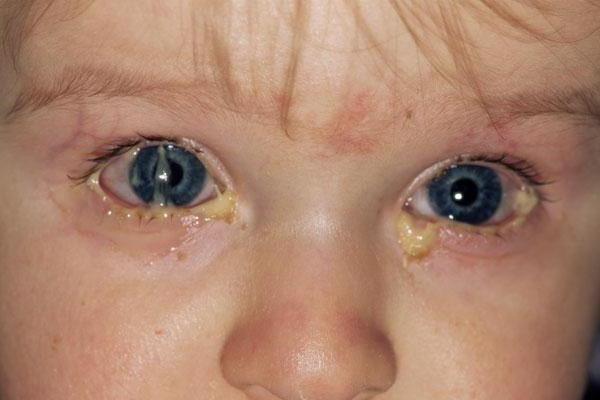 У дитини нежить і гнояться очі: причини і лікування