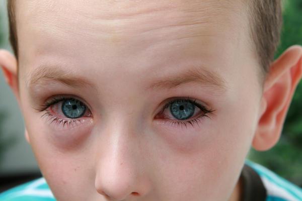 У дитини сльозяться очі і нежить: як швидко вилікувати, що робити