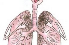 Чи можливо лікування туберкульозу народними засобами в домашніх умовах?