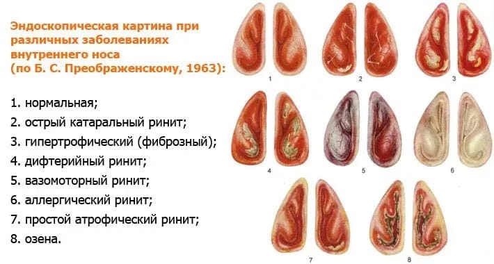 12 симтопов хронічного гіпертрофічного риніту - методи лікування