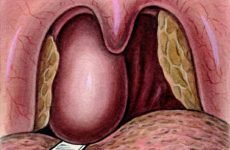Абсцес горла – лікування, симптоми, причини та наслідки