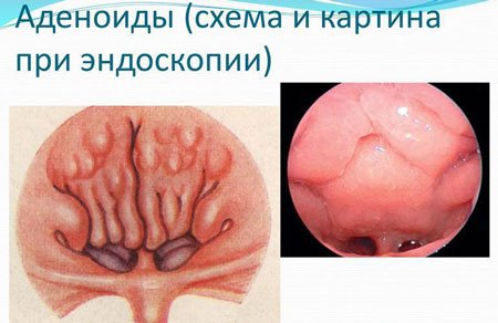 Аденоїдит: лікування і симптоми гострої і хронічної форми