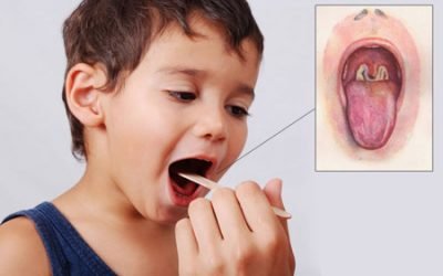 Білий наліт на мигдалинах в горлі у дитини – причини появи