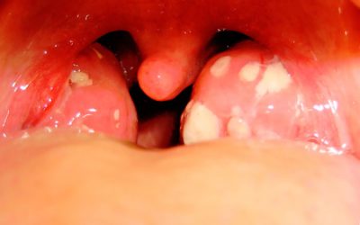 Гнійники в горлі – причини появи та методи лікування