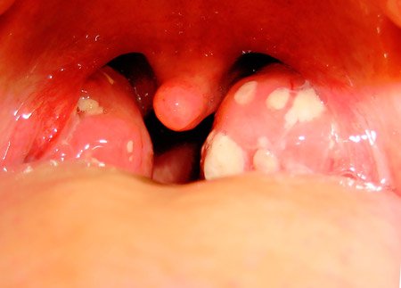 Гнійники в горлі – причини появи та методи лікування