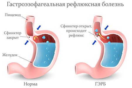 Ком в горлі після їжі   що це може бути, причини і лікування