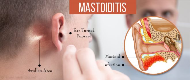 Мастоїдит: симптоми, причини, лікування та профілактика
