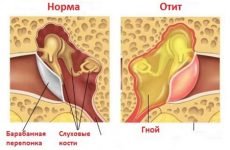 Отит вуха: симптоми, причини, лікування