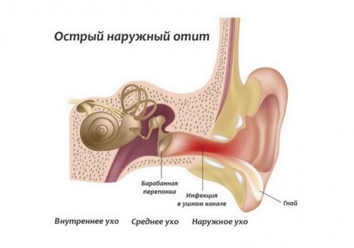 Отит вуха: симптоми, причини, лікування