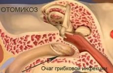 Отомикоз (грибок у вухах): симптоми, причини і лікування