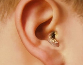 Отомикоз (грибок у вухах): симптоми, причини і лікування