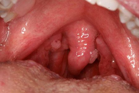 Папілома в горлі, папіломатоз гортані – лікування у дітей та дорослих