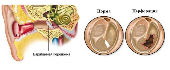 Перфорація (розрив) барабанної перетинки: симптоми і лікування