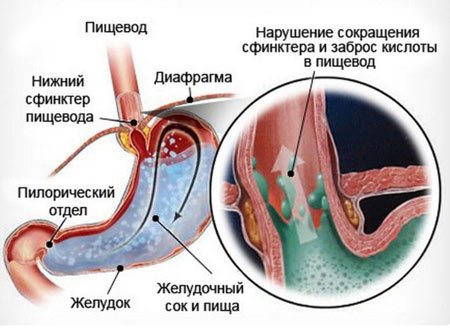Постійна відрижка повітрям і ком у горлі – причини