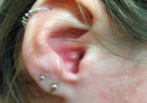 Прищі у вухах: причини, лікування, профілактика