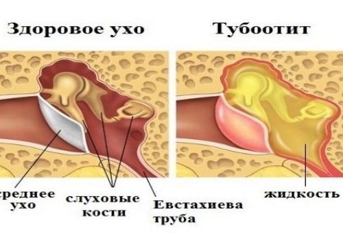 Тубоотит (євстахіїт): симптоми, ускладнення та лікування