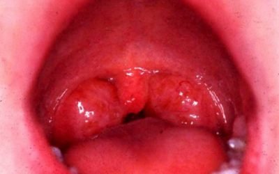 Алергічний тонзиліт: симптоми і причини виникнення, лікування
