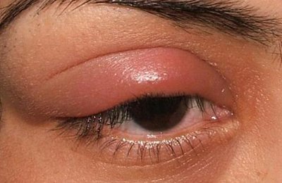 Чому зявляється біль в очах при застуді: офтальмологічні ускладнення при ГРЗ та їх лікування
