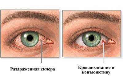 Чому зявляється біль в очах при застуді: офтальмологічні ускладнення при ГРЗ та їх лікування
