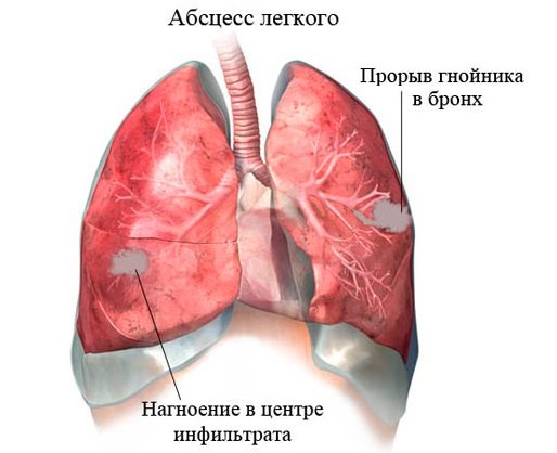 Причини кашлю з кровю при застуді: методи діагностики та лікування