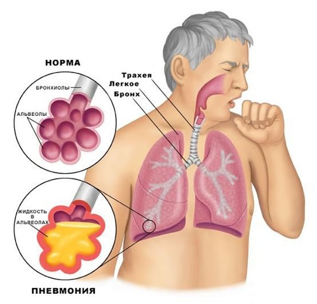 Причини затяжного кашлю після ГРВІ та застуди: способи лікування та профілактики